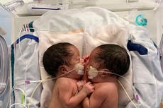 Siameses celebran su primer cumpleaños luego de exitosa cirugía de separación