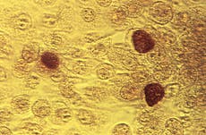 Epidemia de ETS en EEUU se ralentiza con la reducción de nuevos casos de sífilis y gonorrea
