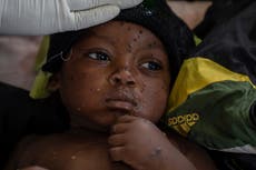 La ONU autoriza la primera vacuna infantil contra la viruela símica en el Congo