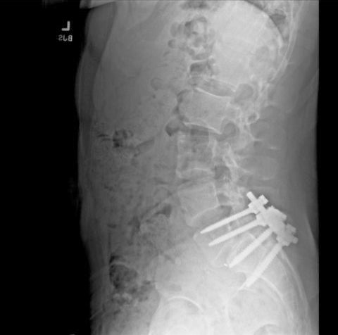 Mangione publicó esta imagen en X, que muestra una columna vertebral con clavos