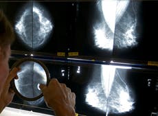 Algunas pacientes de cáncer de mama podrían evitar ciertas cirugías, sugieren estudios
