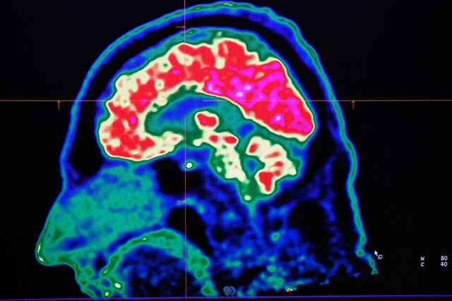 <p>Imagen de un cerebro humano tomada con un escáner de tomografía por emisión de positrones, también llamado PET</p>