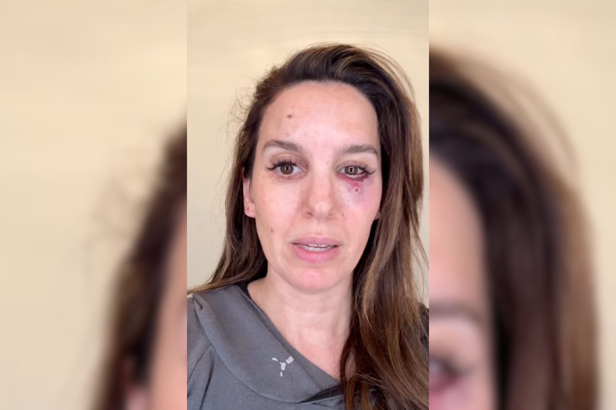 Christy Carlson Romano muestra una herida tras recibir un disparo en la cara