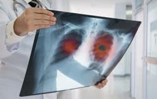 Estos problemas de salud podrían indicar cáncer de pulmón, según expertos