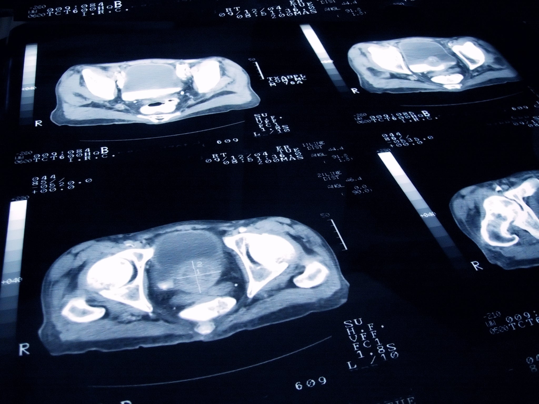 Un cribado de cáncer de próstata