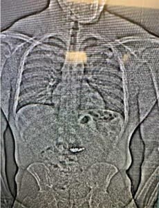 Ladrón se traga aretes de diamantes durante su arresto, informa la policía de Florida