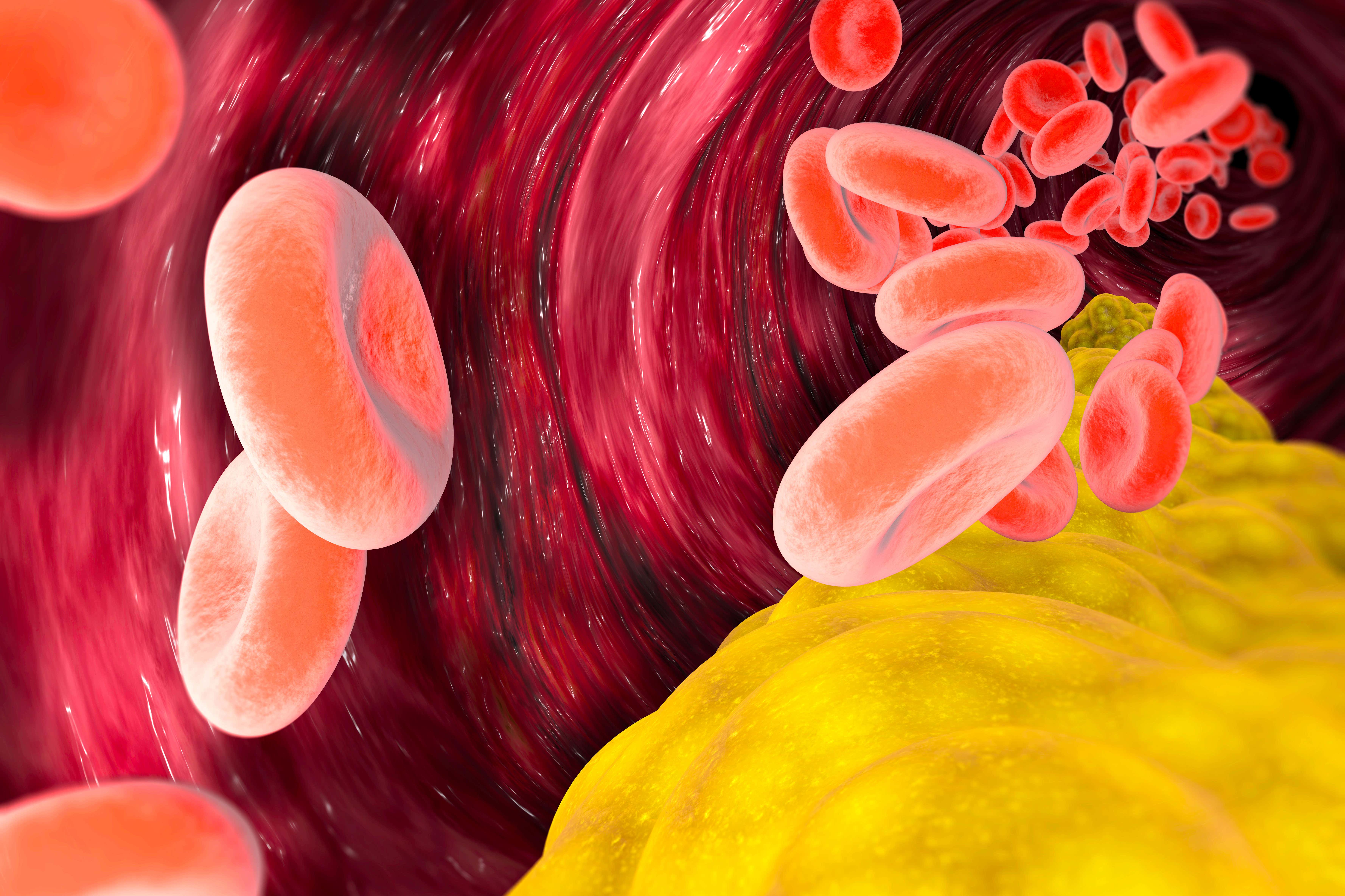 Las LDL (lipoproteínas de baja densidad) pueden contribuir a la formación de placa en las arterias