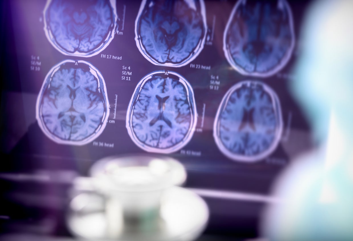 Investigaciones anteriores han relacionado el estar sentado con la demencia. Además, las personas mayores que permanecían sentadas más de 10 horas al día presentaban un mayor riesgo de desarrollar la enfermedad de Alzheimer