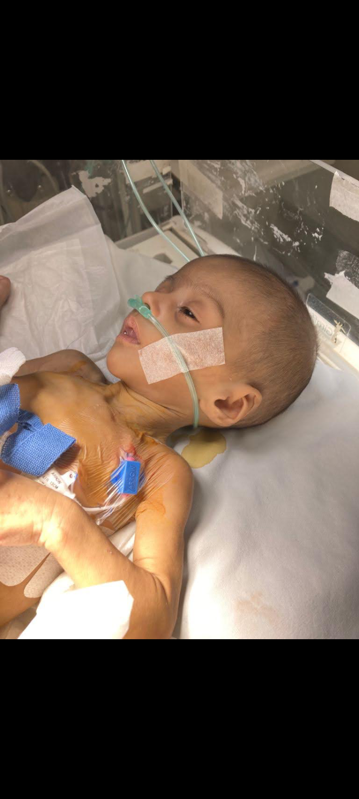 Sofía nació un mes antes de tiempo y tuvo que someterse a seis intervenciones quirúrgicas debido a una obstrucción intestinal. En México, los médicos apenas lograban controlar su afección