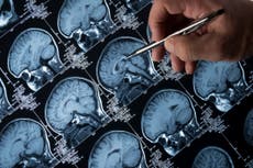 “Fármaco milagroso” para el Alzheimer retrasa cuatro años el avance de la enfermedad