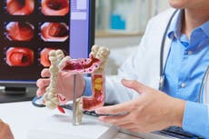 Cientificos celebran avance en investigaciones sobre el cáncer de colon