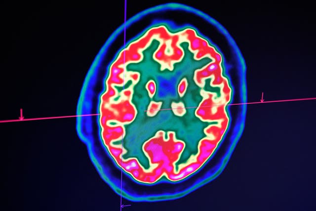 <p>Imagen de un cerebro humano tomada mediante un escáner PET. Nueve de enero de 2019, Centro Hospitalario Regional y Universitario de Brest</p>