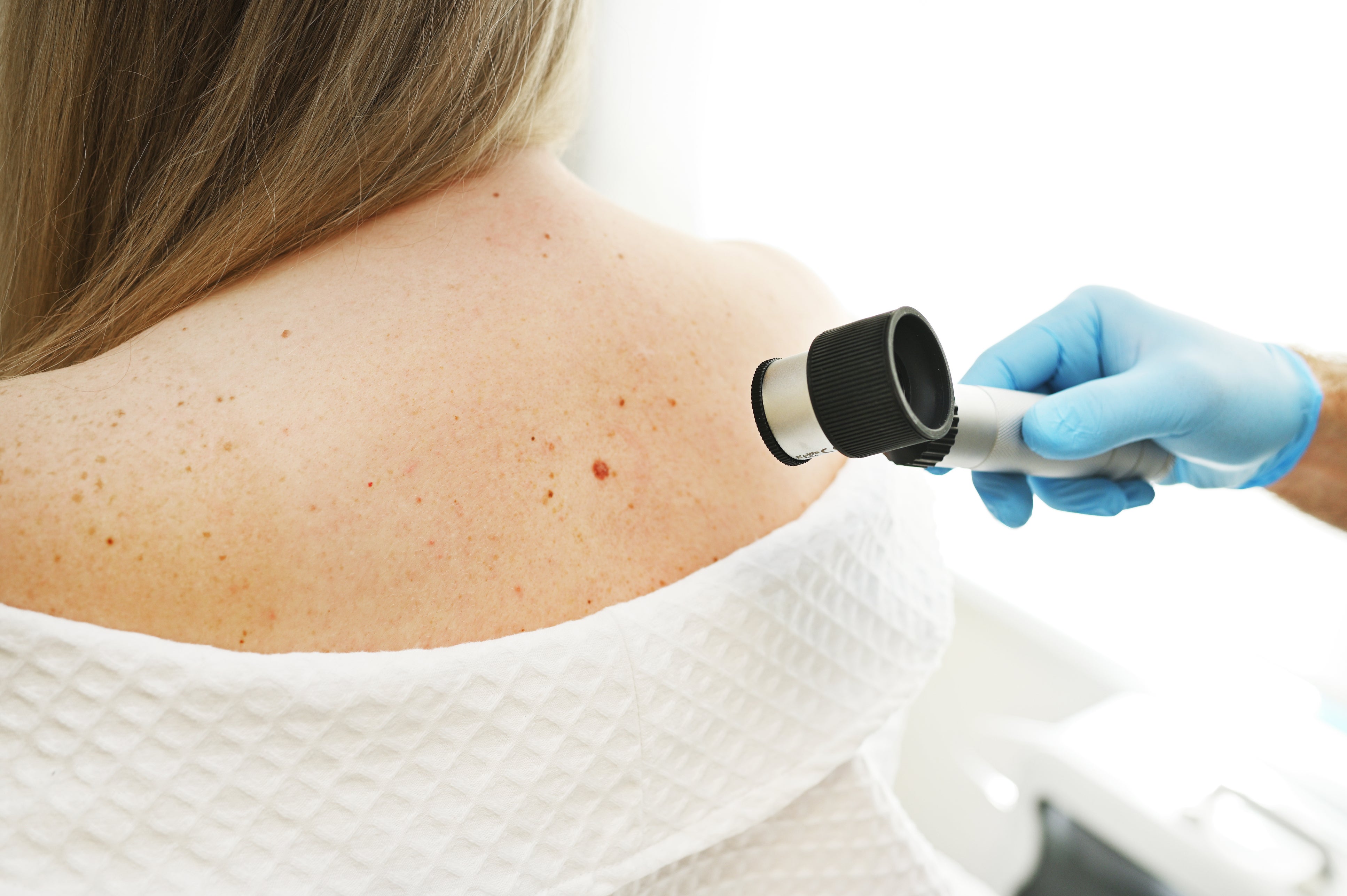 Un dermatólogo examina lunares y lesiones en la piel de un paciente con un dispositivo especializado