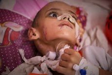 Un niño con lesión cerebral lucha por su vida en el colapsado sistema de salud de Gaza