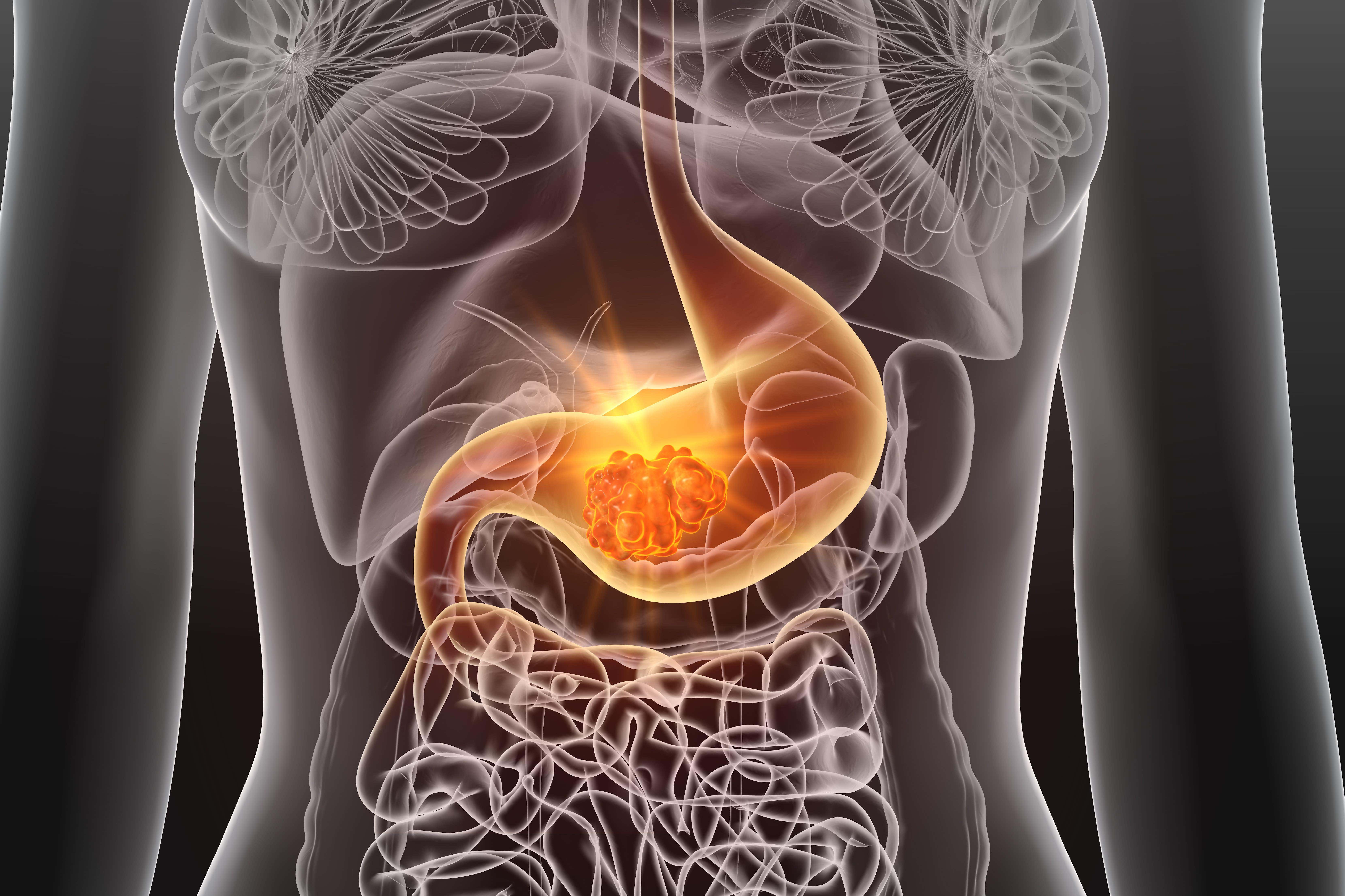 La bacteria Helicobacter pylori se transmite principalmente a través de agua y alimentos contaminados, y su tratamiento habitual consiste en el uso de antibióticos