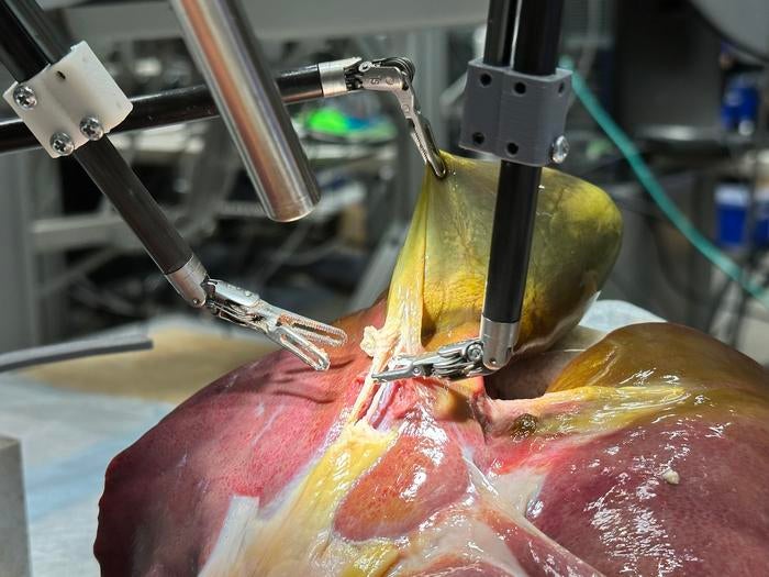 Se trata de la primera intervención quirúrgica realista realizada por un robot sin asistencia humana. Investigadores de la Universidad Johns Hopkins informaron el miércoles que el robot quirúrgico Transformer-Hierarchy fue entrenado con videos quirúrgicos para realizar una compleja fase de extirpación de la vesícula biliar en un modelo de paciente realista