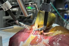 Un robot podría realizar tu próxima cirugía