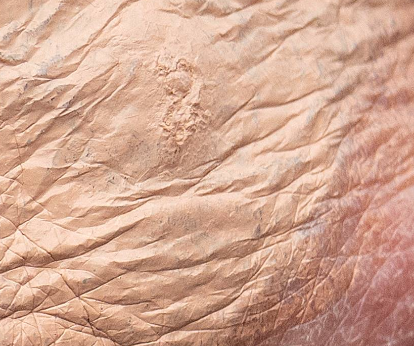 Una zona de la mano de Trump mostraba lo que parecía ser una cicatriz en relieve