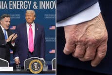 Trump reaparece con moretones en la mano antes de ir a Pittsburgh 
