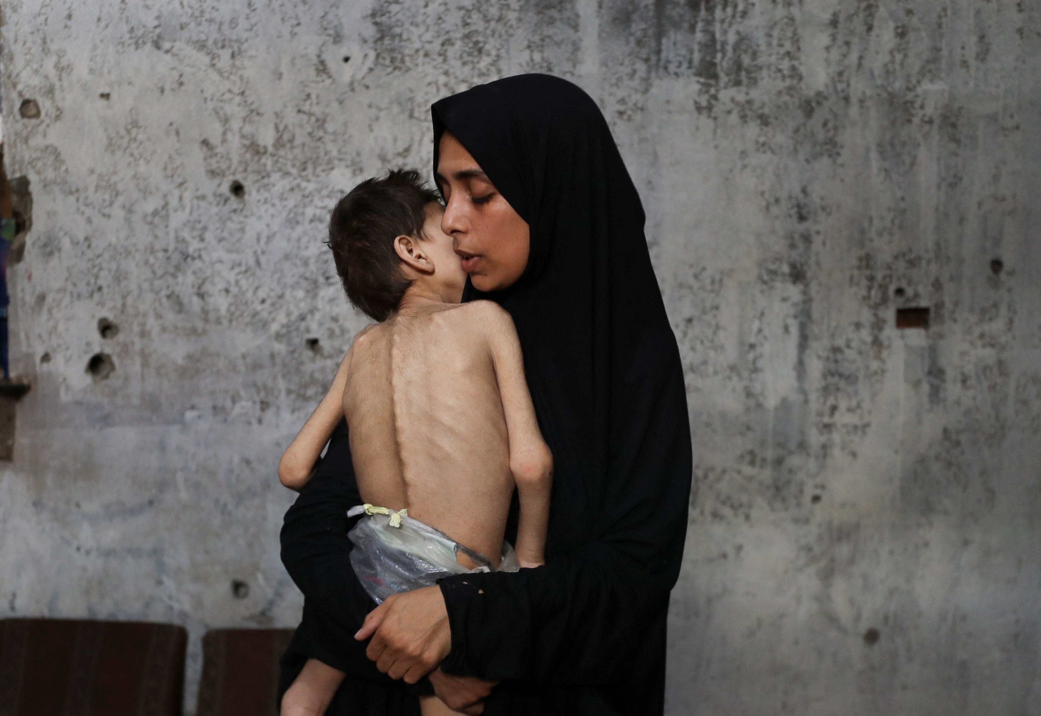 La madre palestina desplazada Samah Matar sostiene a su hijo desnutrido Youssef en la ciudad de Gaza