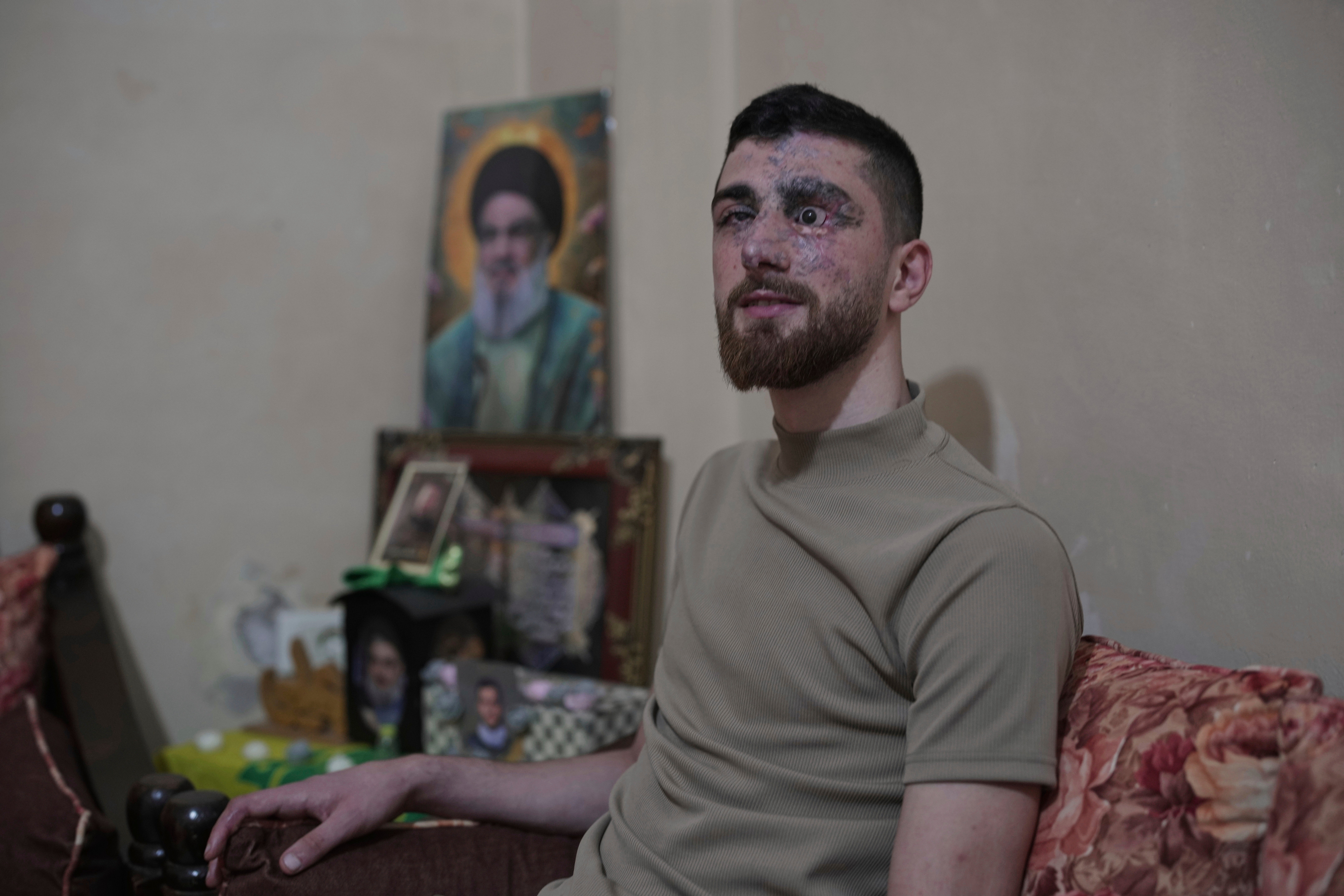 LIBANO-HEZBOLLAH-EXPLOSIONES BÍPERS-SOBREVIVIENTES