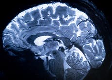 Descubren el nutriente cuya deficiencia podría contribuir al Alzheimer