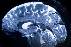 Descubren el nutriente cuya deficiencia podría contribuir al Alzheimer