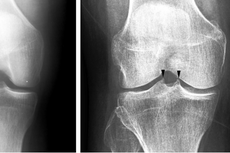 Un pequeño cambio en la forma de caminar podría aliviar la artrosis en las rodillas