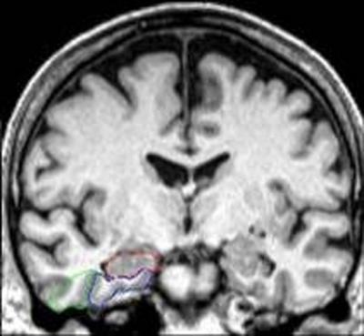 Una resonancia magnética cerebral muestra áreas de interés en el lóbulo temporal medial: hipocampo (en rojo), corteza entorrinal (en azul) y corteza perirrinal (en verde)