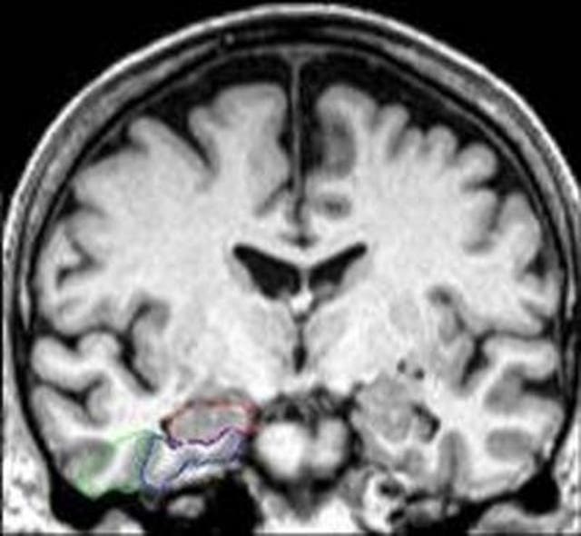 <p>Una resonancia magnética cerebral muestra áreas de interés en el lóbulo temporal medial: hipocampo (en rojo), corteza entorrinal (en azul) y corteza perirrinal (en verde)</p>