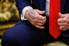 Trump deja ver un gran moretón en su mano en medio de especulaciones sobre su salud