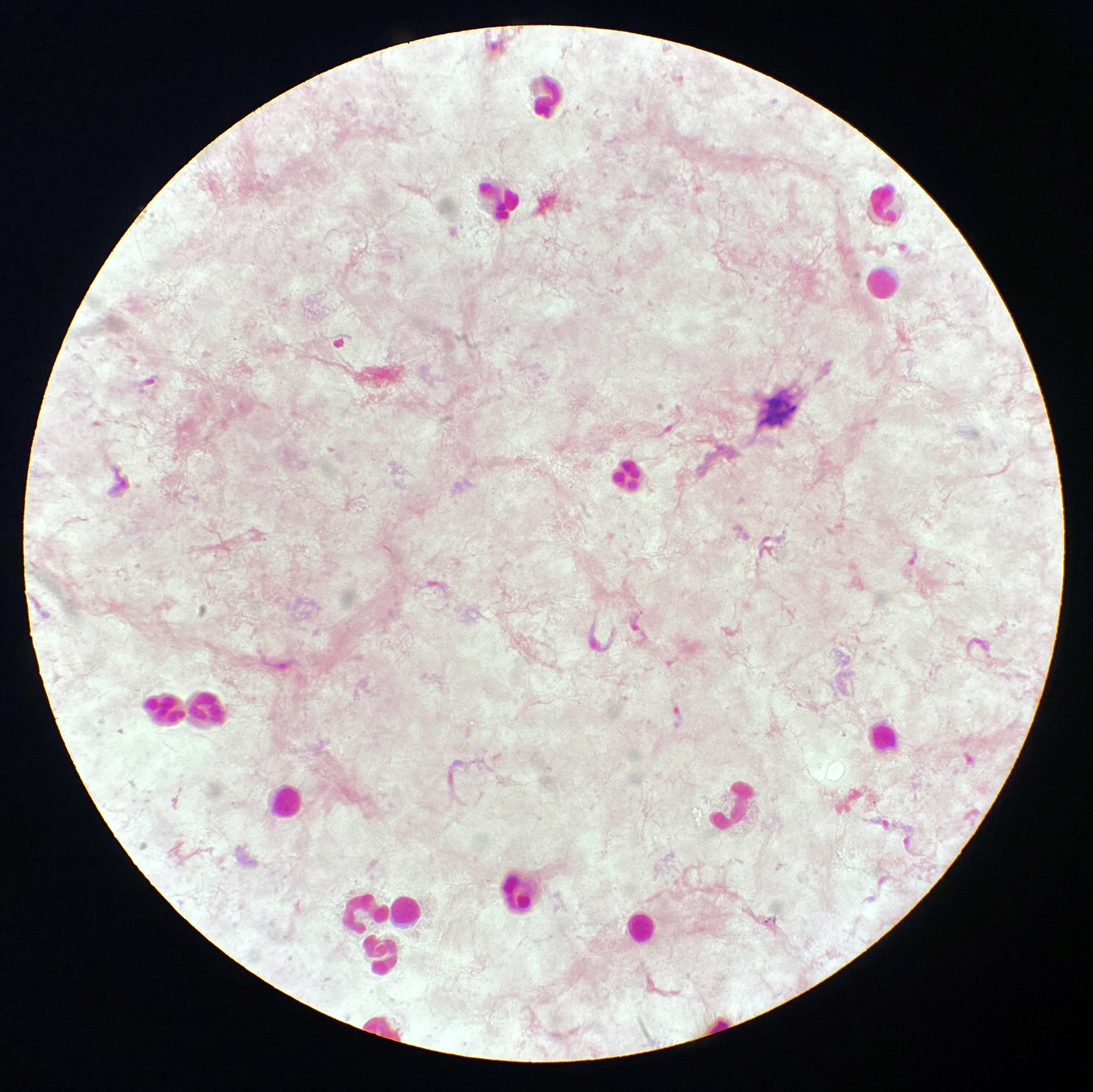 Alrededor de 75 millones de personas corren riesgo de infección en todo el mundo