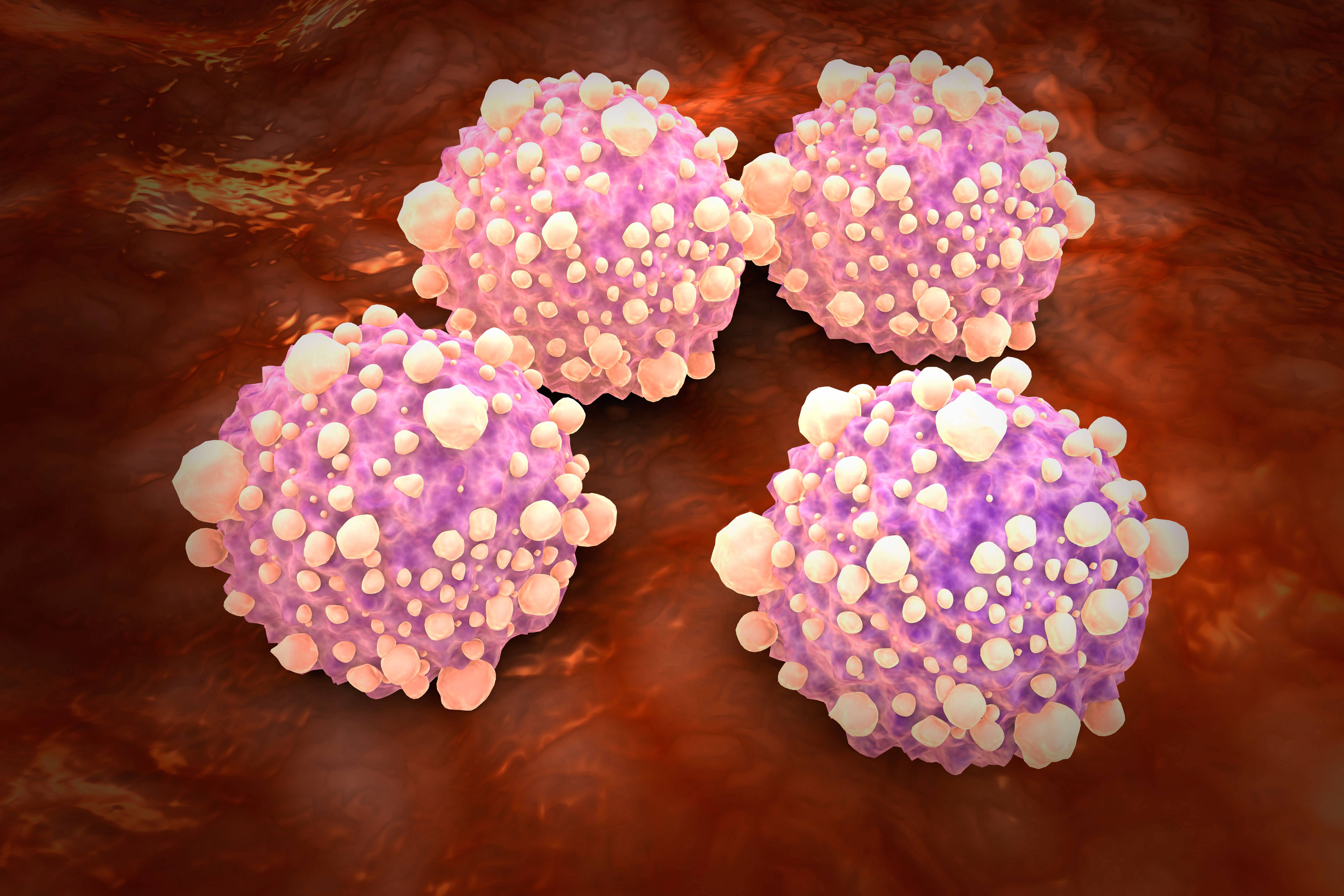 La mayoría de los pacientes de cáncer de páncreas en Inglaterra y Gales se diagnostican en una fase avanzada cuatro