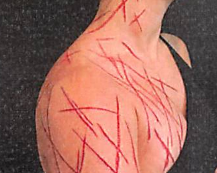 Las lesiones de Greene coinciden con las indicaciones detalladas que dio a un artista de modificación corporal