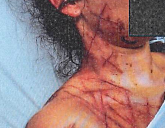 Greene presentaba numerosas cicatrices y laceraciones infligidas, según ella, durante su presunto secuestro