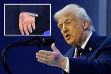 Trump exhibe un gran hematoma en su otra mano durante discurso en Davos