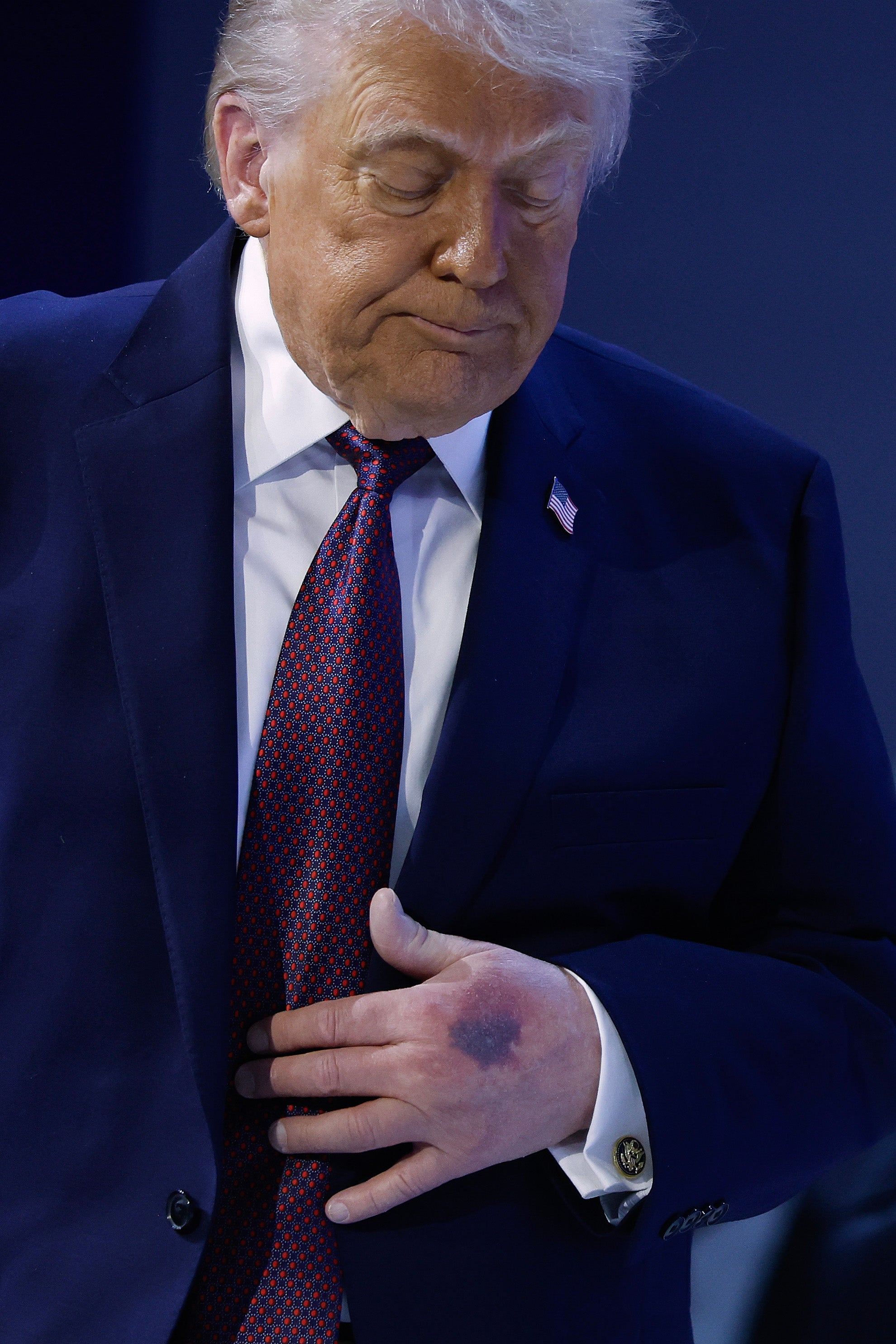 El hematoma en la mano izquierda de Trump era prominente en las fotos tomadas el jueves en el Foro Económico Mundial
