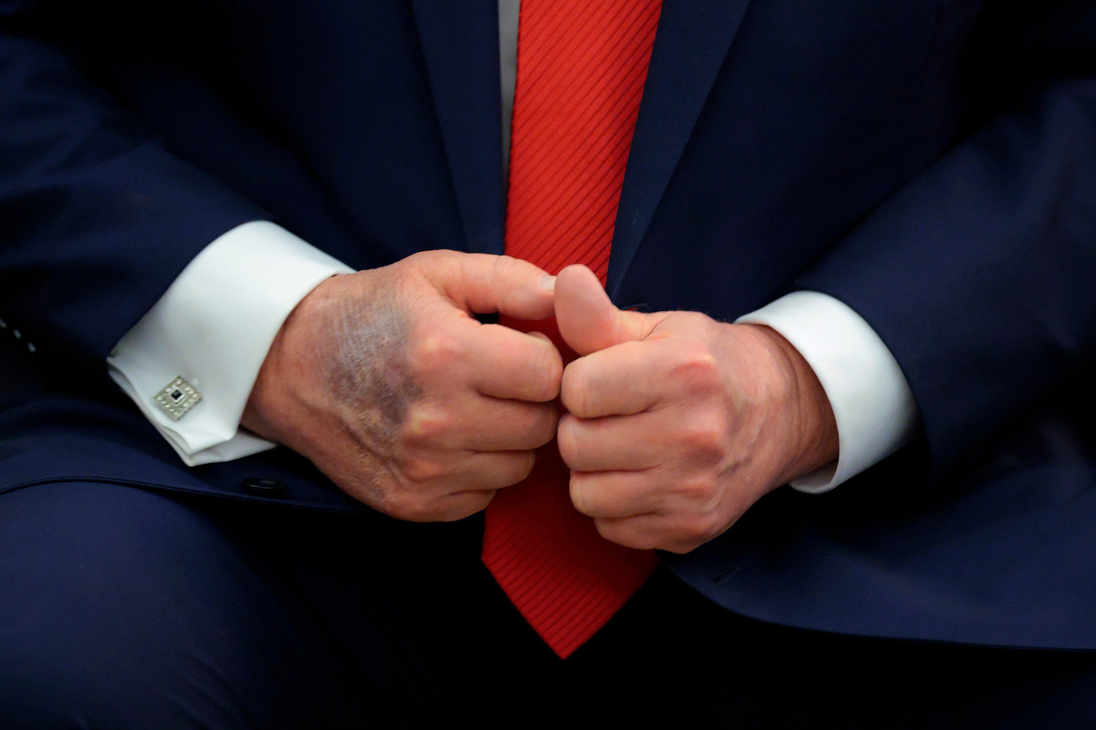 A large bruise is seen on the back of Trump’s right hand in August 2025