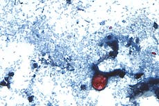 Casos de cyclospora en EEUU alcanzan cifras récord; Michigan apunta a la lechuga como posible causa