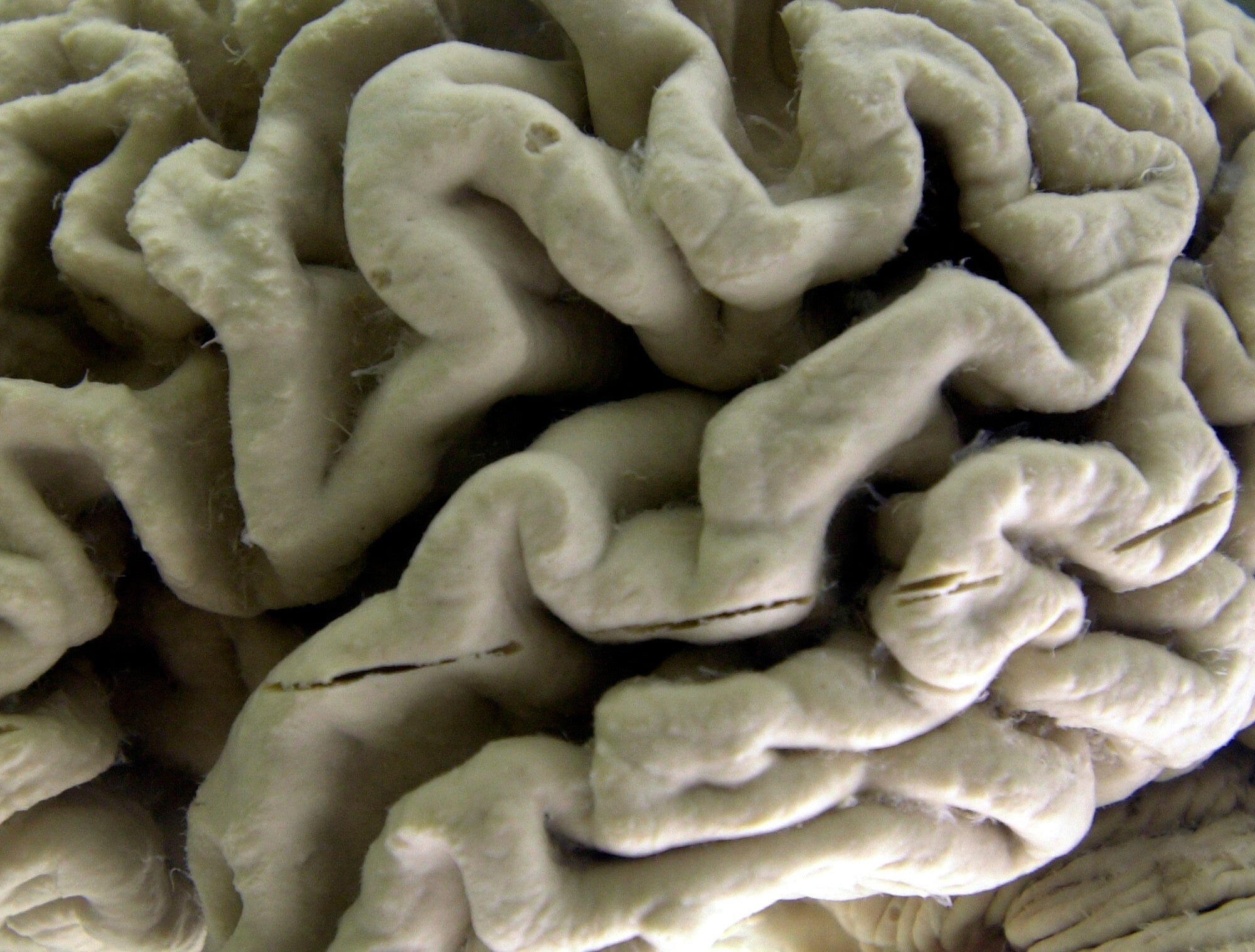 ALZHEIMER-ANÁLISIS DE SANGRE