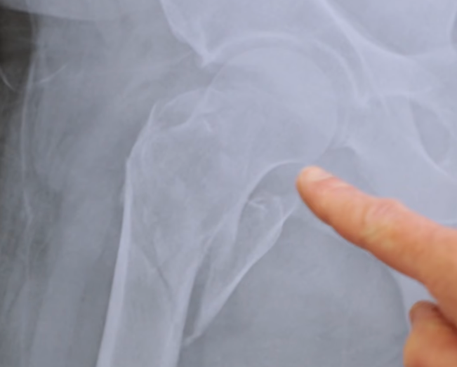 El bisonte causó a la víctima, Carl, una lesión “dolorosa”; la radiografía reveló que el fémur del paciente se había fracturado en varios pedazos