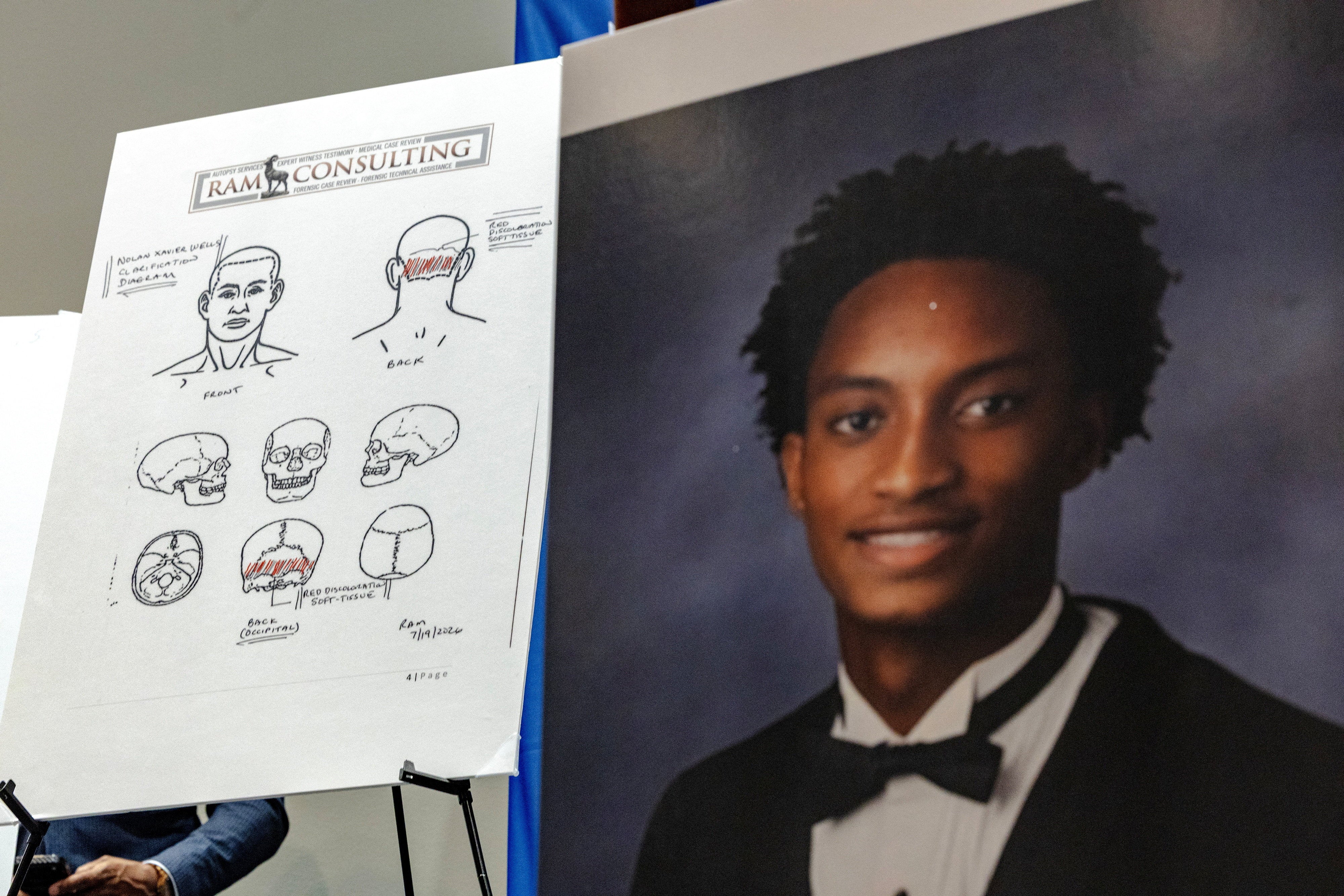 Durante el anuncio de los resultados de una autopsia independiente realizada al joven negro cuyo cadáver fue hallado en una isla frente a la costa de Misisipi, se muestran diagramas en los que se representan las partes del cuerpo de Nolan Wells