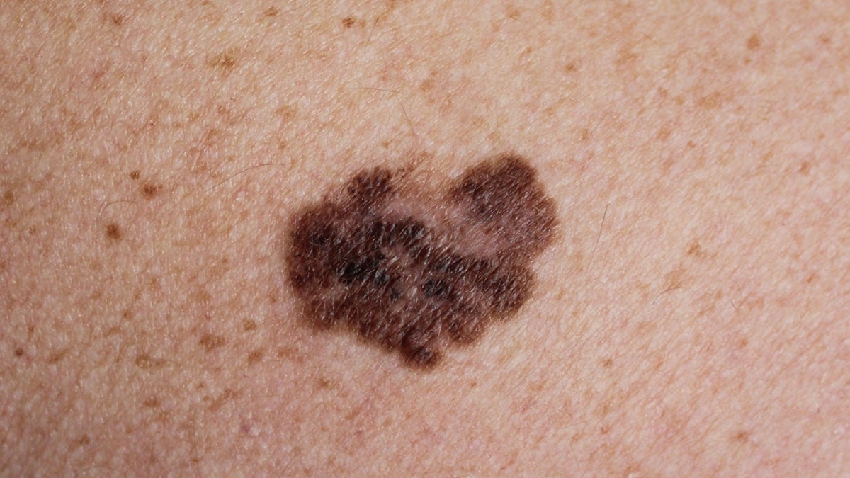 El melanoma es la forma más mortal de cáncer de piel