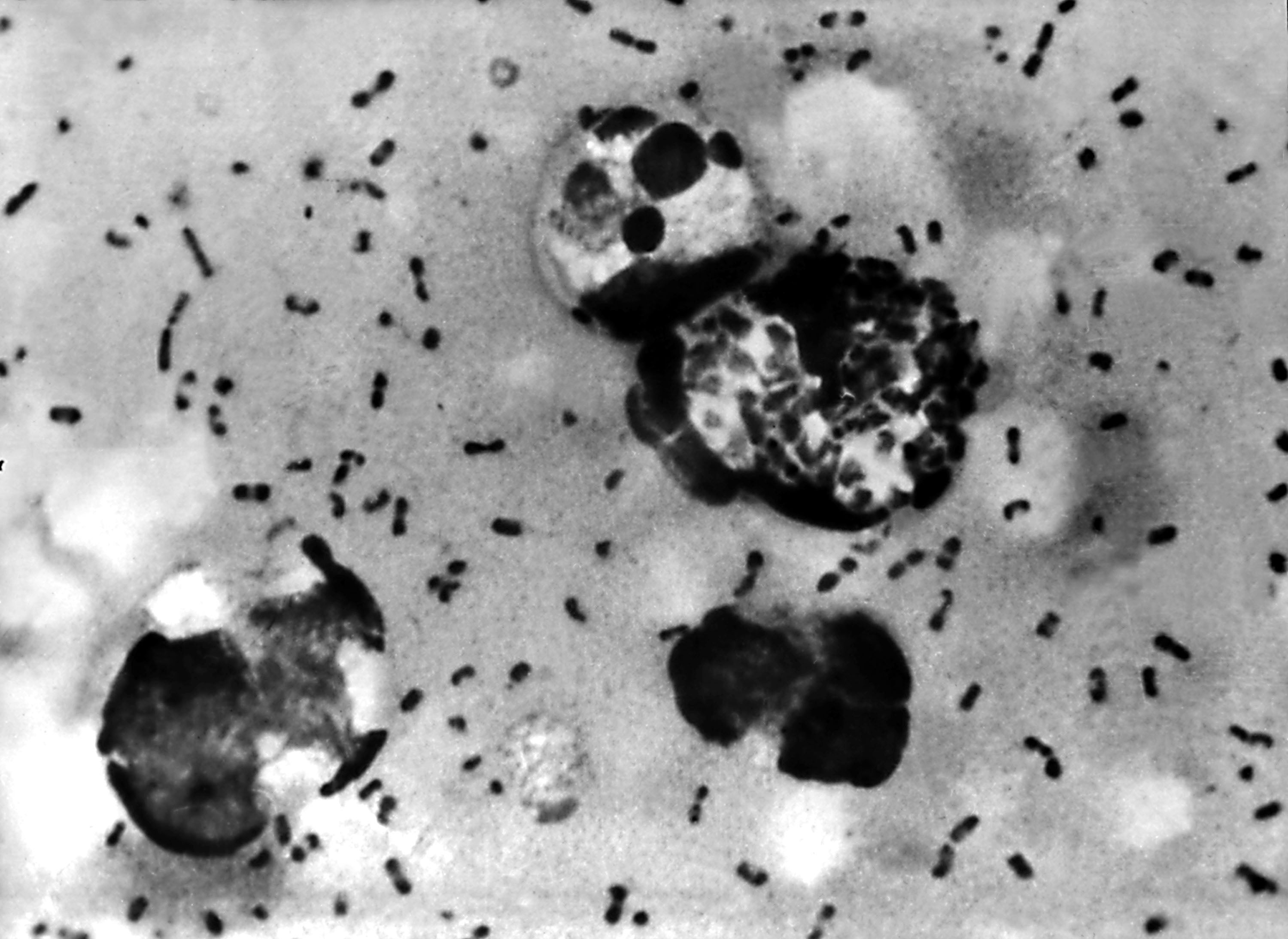 La peste neumónica afecta a los pulmones y puede transmitirse fácilmente de una persona a otra a través de las gotículas respiratorias en el aire