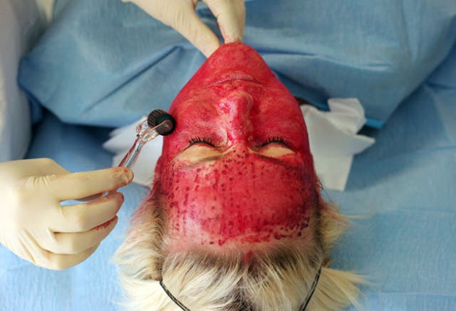 <p>El plasma rico en plaquetas, también conocido como “facial vampiro”, ofrece una alternativa a las cirugías estéticas</p>
