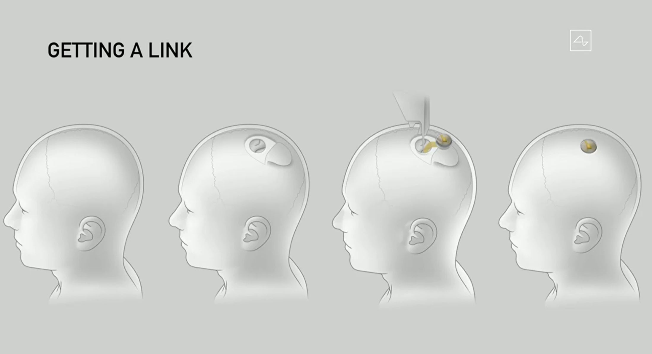 Elon Musk dijo que el dispositivo Neuralink reemplazaría un trozo de cráneo sin causar ningún daño duradero al cerebro.